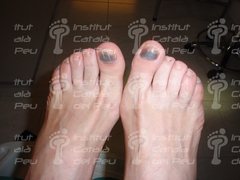 Онихолизис (отслоение ногтя) – причины, симптомы, лечение